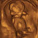 11 hetes magzat ultrahang képe - CsodaBent 4d ultrahang