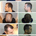 Hair Implantasjon og pigmentering - PHAEYDE Clinic