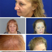 En vanskelig sak: translantation av blondt hår - PHAEYDE Clinic