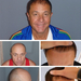 En annen 9000+ Hair Transplant - PHAEYDE Clinic
