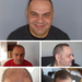 Hair Transplant i flere soner - PHAEYDE Clinic