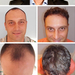 Trapianto di capelli di 4000 + Capelli - PHAEYDE Clinic