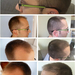 hair-transplant-fue-results-before-after-photos-aaron-p en