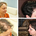 Hair transplant&nbsp;before&nbsp;after&nbsp;result&nbsp;photos&n