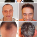 Photo&nbsp;isolated&nbsp;results&nbsp;of&nbsp;hair transplantati