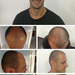 Hair transplant&nbsp;before&nbsp;and&nbsp;after&nbsp;the&nbsp;tr