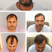 Hair transplantation&nbsp;in&nbsp;documented&nbsp;by&nbsp;beauti