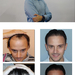 Hair transplant&nbsp;with&nbsp;FUE method&nbsp;at&nbsp;a&nbsp;hi