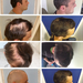 Hair transplant&nbsp;before&nbsp;after&nbsp;photos&nbsp;and&nbsp