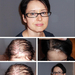 Fue&nbsp;hair&nbsp;implant&nbsp;results&nbsp;on&nbsp;photos&nbsp