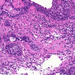 bronchus-metaplasia-dysplasia-carcinomamár rákos, rossz helyen, 