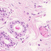 carcinoma ductale invasivum mammae myoepithel