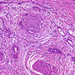carcinoma pancreatis perineurális terjedés