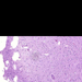 glioblastoma multiforme oedema