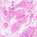 mastopathia fibrocystica fibrosis