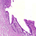 Ulcus pepticum ventriculi kezd gyógyulni, mászik rá egy rétegben