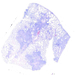 tuberculosis pulmonis (ZN)