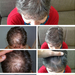 Weibliche Haarausfall &amp; die Heilung = Haartransplantation - 