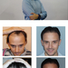 Haartransplantation für Manner - PROHAARKLINIK