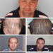 FUE haartransplantatie 8000+- PHAEYDE Clinic