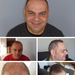 Hair Transplant in meerdere zones- PHAEYDE Clinic