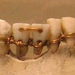 4000 éves múmia. A két középső foga donor fogak.